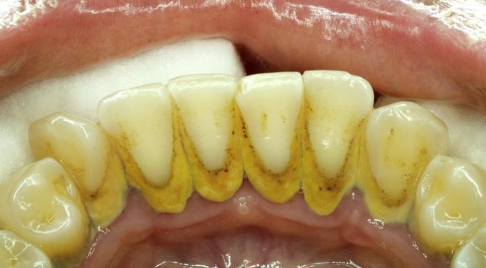 Sastojkom iz kuće riješite se kamenca,plaka i bakterija vrlo jednostavno