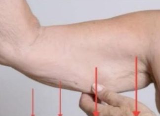 EVO ZAŠTO IMATE NEOBIČNO OBJEŠENU KOŽU- Većina ljudi nemapojma o ovom problemu. Jedino efikasno rješenje je ovaj domaći trik