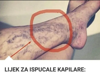 Svatko kod kuće ima lijek za popucale kapilare, ali mnogi ljudi to ne znaju!