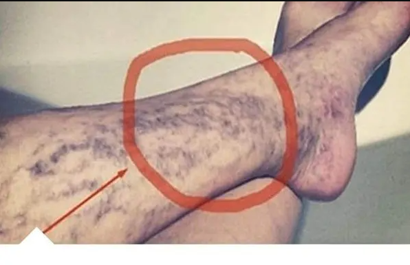 Svatko kod kuće ima lijek za popucale kapilare, ali mnogi ljudi to ne znaju!