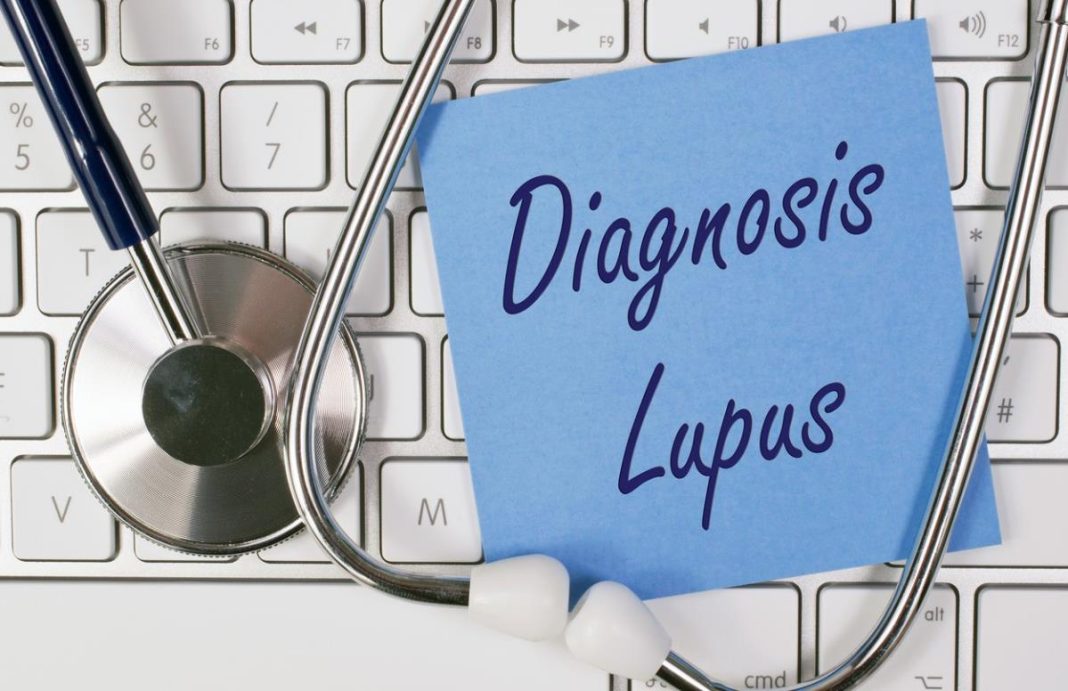 Lupus se često krije iza bezopasnih simptoma: Ovo su rani znaci koje ne smete ignorisati - featured image Lupus se često krije iza bezopasnih simptoma: Ovo su rani znaci koje ne smete ignorisati - featured image