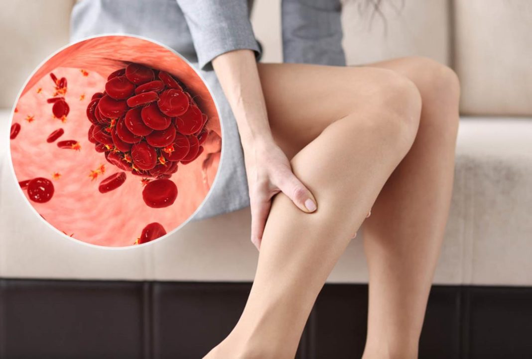 Kako da prepoznate tromb u telu? Ne ignorišite ovih 8 znakova upozorenja - featured image Kako da prepoznate tromb u telu? Ne ignorišite ovih 8 znakova upozorenja - featured image