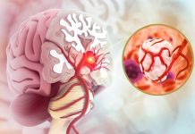 Imate često jake glavobolje ili vrtoglavicu? Možda biste trebali posjetiti ljekara: 9 simptoma tumora na mozgu koje ne smete ignorisati Glavobolje, napadi ili problemi s govorom? 9 simptoma tumora na mozgu koje ne smete ignorisati - featured image