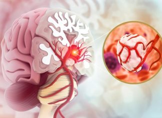 Imate često jake glavobolje ili vrtoglavicu? Možda biste trebali posjetiti ljekara: 9 simptoma tumora na mozgu koje ne smete ignorisati Glavobolje, napadi ili problemi s govorom? 9 simptoma tumora na mozgu koje ne smete ignorisati - featured image