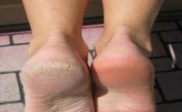 Zaboravite na ispucale pete, kurje oko i gljivice na nogama: Ova Jeftina namirnica je pravi spas Zaboravite na ispucale pete, kurje oko i gljivice na nogama: Ova Jeftina namirnica je pravi spas - featured image