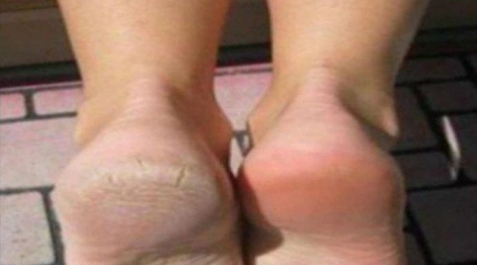 Zaboravite na ispucale pete, kurje oko i gljivice na nogama: Ova Jeftina namirnica je pravi spas Zaboravite na ispucale pete, kurje oko i gljivice na nogama: Ova Jeftina namirnica je pravi spas - featured image