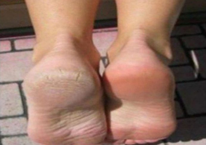 Zaboravite na ispucale pete, kurje oko i gljivice na nogama: Ova Jeftina namirnica je pravi spas Zaboravite na ispucale pete, kurje oko i gljivice na nogama: Ova Jeftina namirnica je pravi spas - featured image