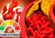 Šest znakova da imate visok holesterol: Ako osećate bol u vratu odmah se javite lekaru