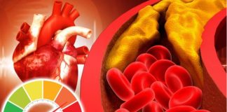 Šest znakova da imate visok holesterol: Ako osećate bol u vratu odmah se javite lekaru