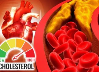 Šest znakova da imate visok holesterol: Ako osećate bol u vratu odmah se javite lekaru