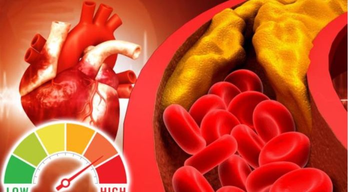 Šest znakova da imate visok holesterol: Ako osećate bol u vratu odmah se javite lekaru