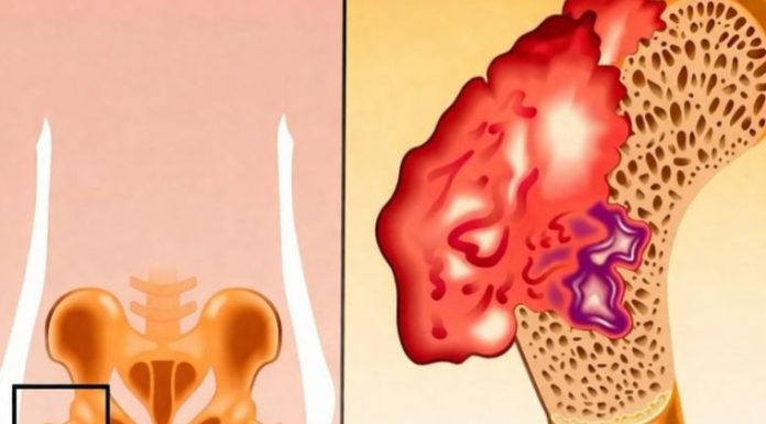 Bol u kostima, visok pritisak i tuga: Tijelo vam govori da mu NEDOSTAJE ovaj važan VITAMIN Bol u kostima, visok pritisak i tuga: Tijelo vam govori da mu NEDOSTAJE ovaj važan VITAMIN - featured image