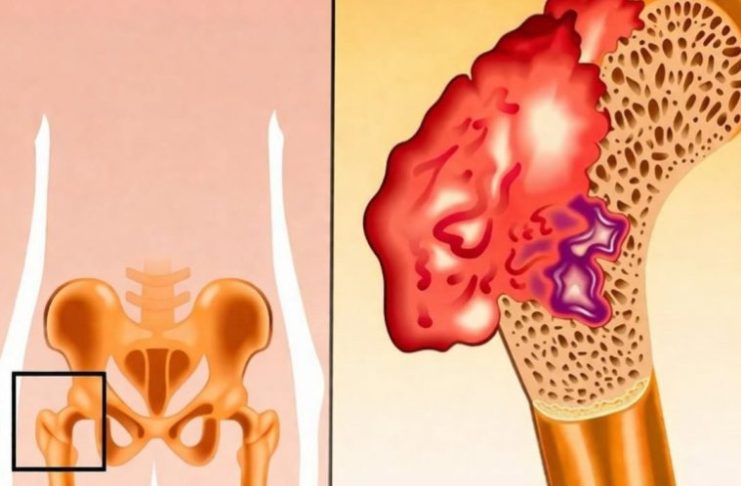 Bol u kostima, visok pritisak i tuga: Tijelo vam govori da mu NEDOSTAJE ovaj važan VITAMIN Bol u kostima, visok pritisak i tuga: Tijelo vam govori da mu NEDOSTAJE ovaj važan VITAMIN - featured image