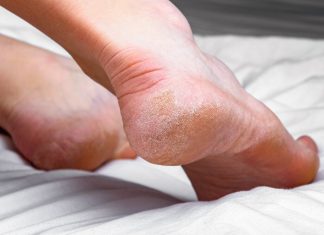 Domaći melem za grube i ispucale pete bake su znale napamet: Koriste se 2 prirodna sastojka Domaći melem za grube i ispucale pete bake su znale napamet: Koriste se 2 prirodna sastojka - featured image