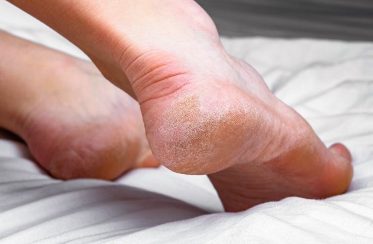 Domaći melem za grube i ispucale pete bake su znale napamet: Koriste se 2 prirodna sastojka Domaći melem za grube i ispucale pete bake su znale napamet: Koriste se 2 prirodna sastojka - featured image